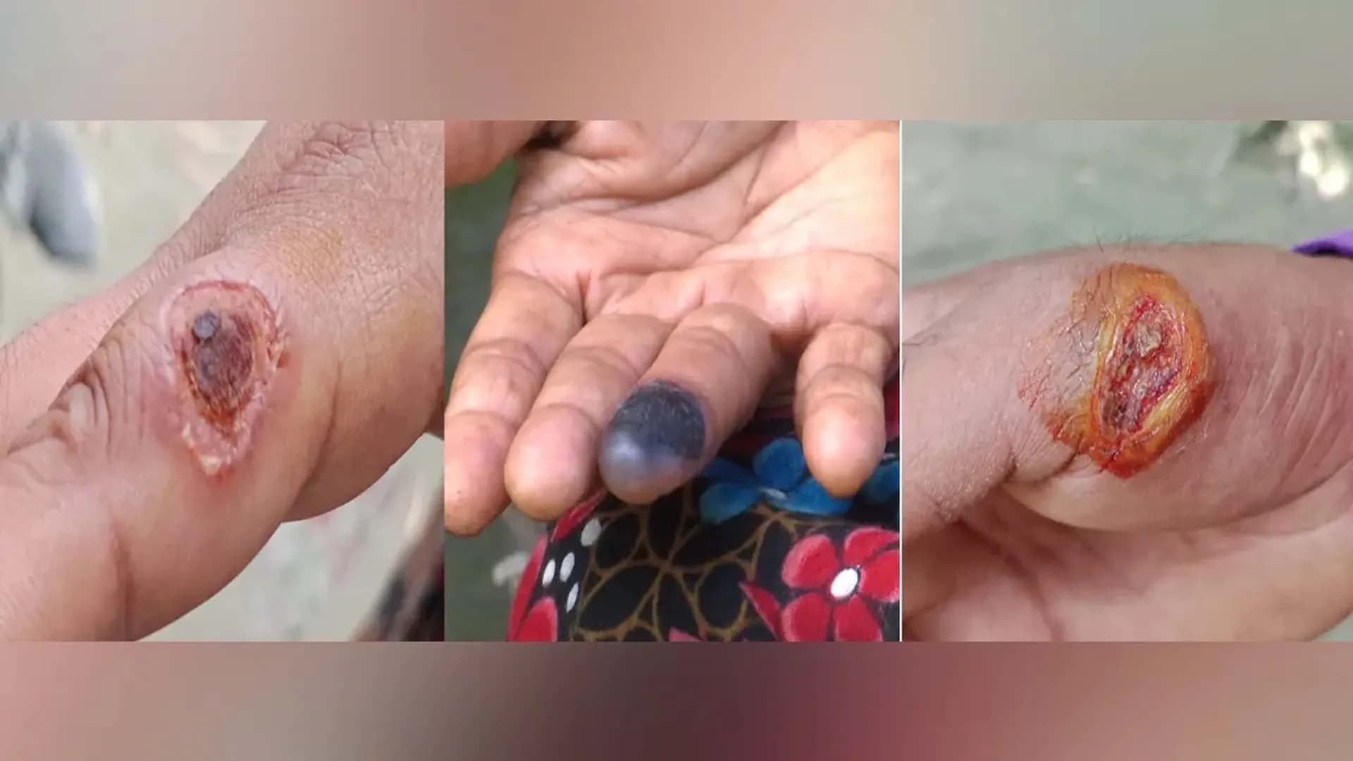 আশঙ্কাজনক হারে ছড়িয়ে পড়ছে পশুবাহিত এক অজানা রোগ